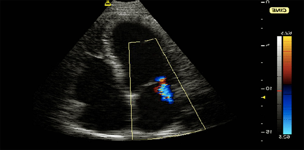 Echocardiogram of patient with trivial mitral regurgitation