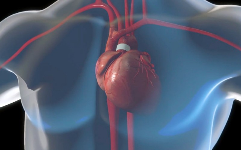 Ejection Fraction (EF): How It Affects People with Mitral Valve Prolapse