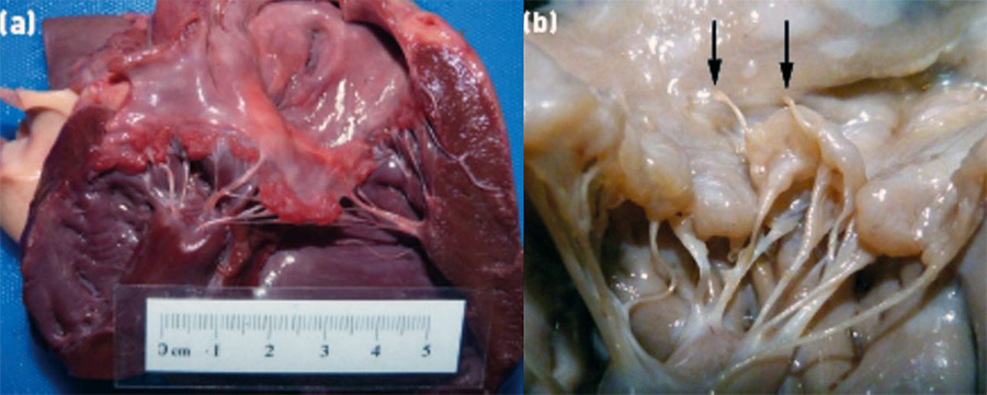 Myxomatous Degeneration