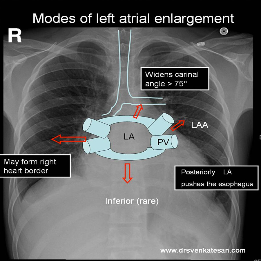X-Ray of a patient with left atrial enlargement